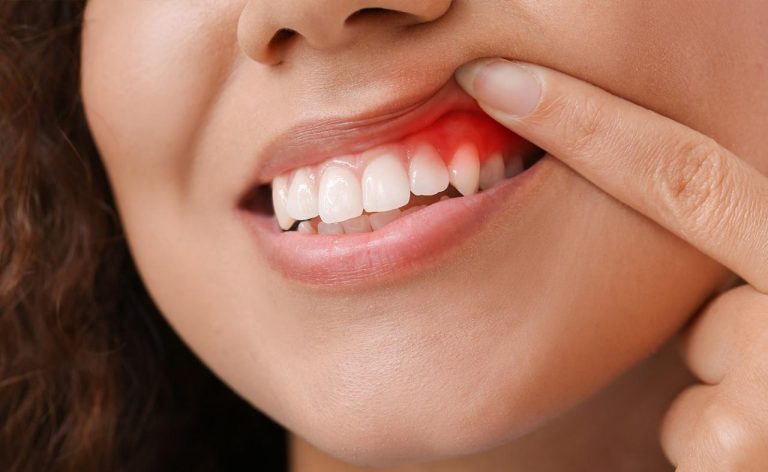 Conheça as 5 doenças bucais que precisam de atenção