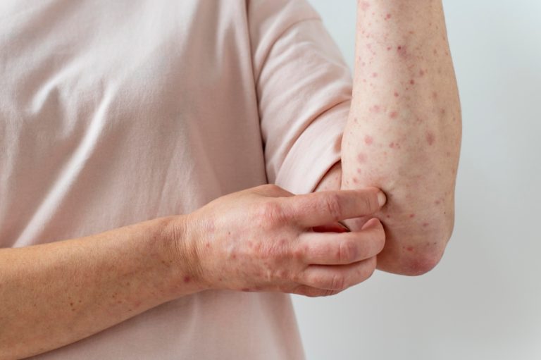 Mpox em Brasília: entenda doença, sintomas, transmissão e prevenção