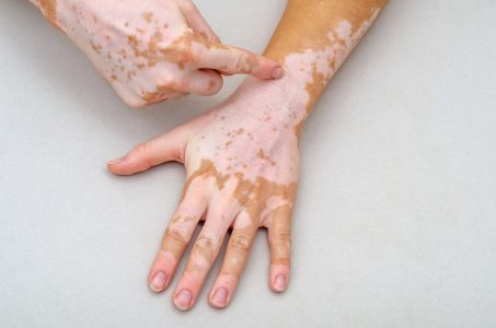 vitiligo