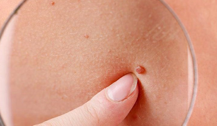 INCA projeta 9.380 novos casos de câncer não melanoma entre homens e mulheres e de 190 casos de câncer melanoma