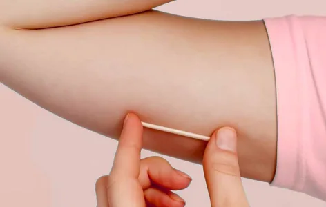Chip anticoncepcional e implantado gratuitamente