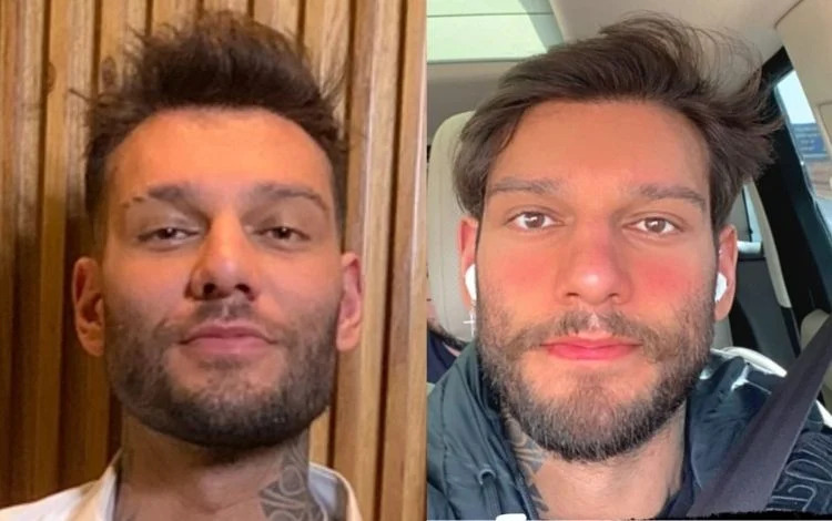 Lucas Lucco antes e depois de desfazer a harmonização facial